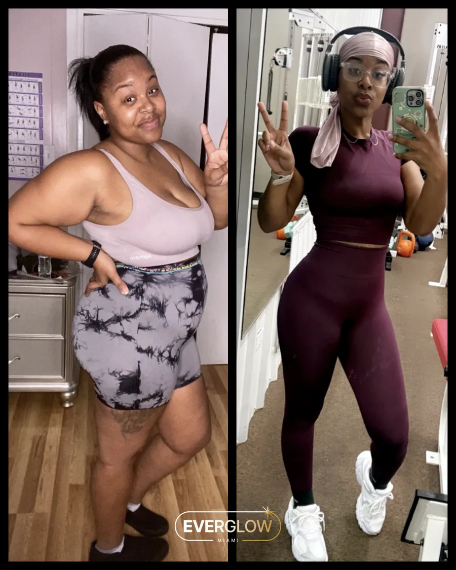 Real Everglow Miami patient weight-loss transformation before and after