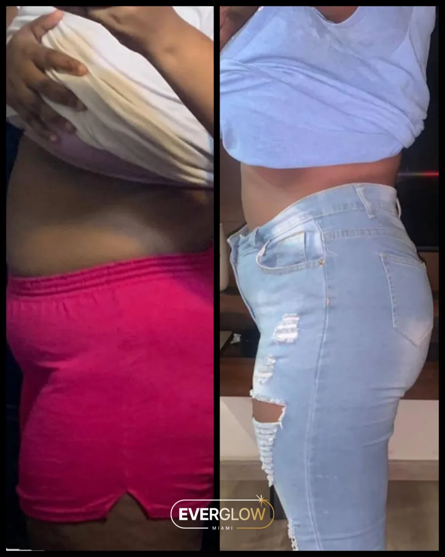 Everglow Miami patient before and after weight loss transformation